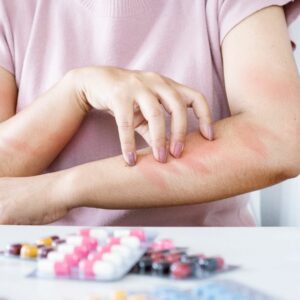 Adverse Effects and Allergic Reactions